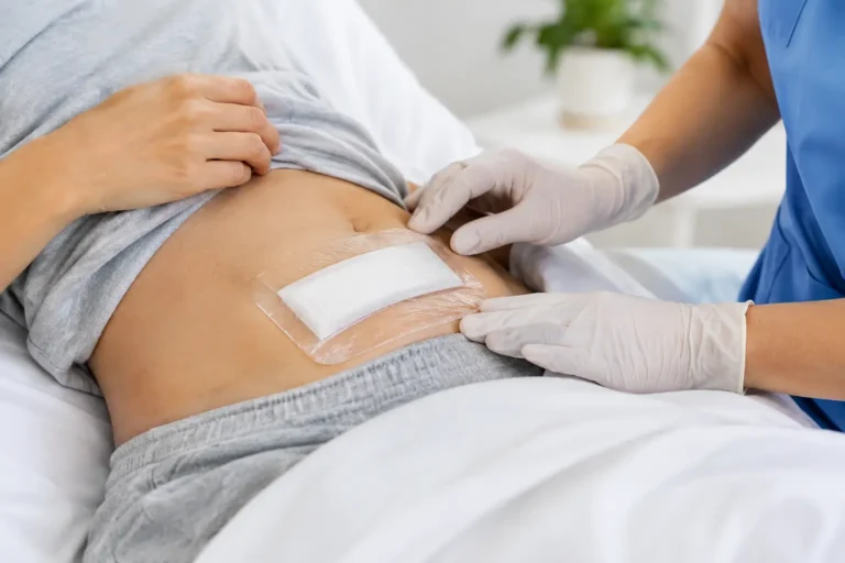 Cómo cuidar una herida quirúrgica abdominal