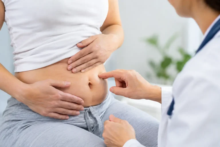 Cómo identificar hernia umbilical y cuándo atenderla